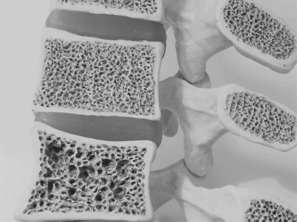 vertebral-fractures-sinead-curran-physiotherapy